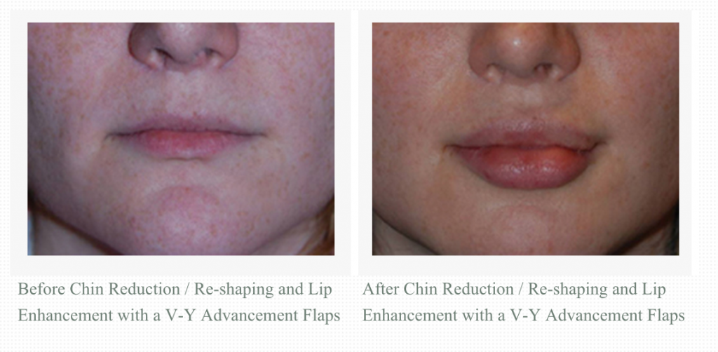 Transgender facial feminization with VY Advancement lip augmentation, and chin reduction