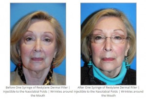 Filler Injectible to Nasolabial Fold Restylane by LA Beverly Hills Trained Award Winning Dr Philip Young