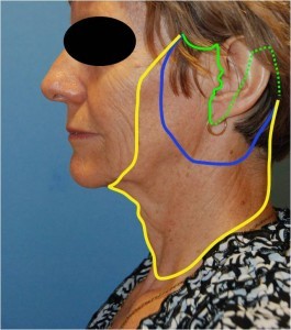 Facelift-figure-8-Different-Variations-of-the-Face-Lift-Dr-Young-Bellevue-Washington