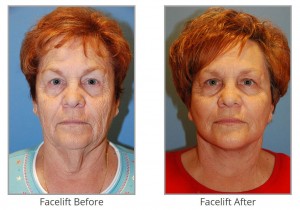 facelift-before-after-image