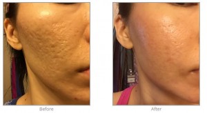 Acne Scar Treatment in Plastic Surgery for Acne Scarring, Microneedling & Radiofrequency #acnescartreatment #beforeandafter