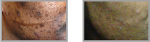 Dark skin acne topical skin care approach