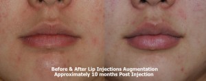 Lips before after filler injections 10 months after